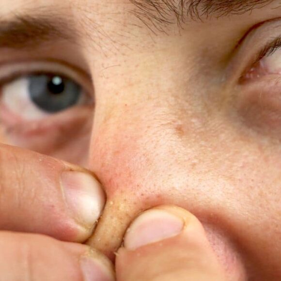 Cette crème à fabriquer chez vous pour éliminer tous les points noirs