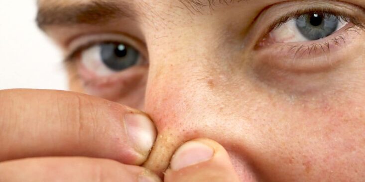 Cette crème à fabriquer chez vous pour éliminer tous les points noirs