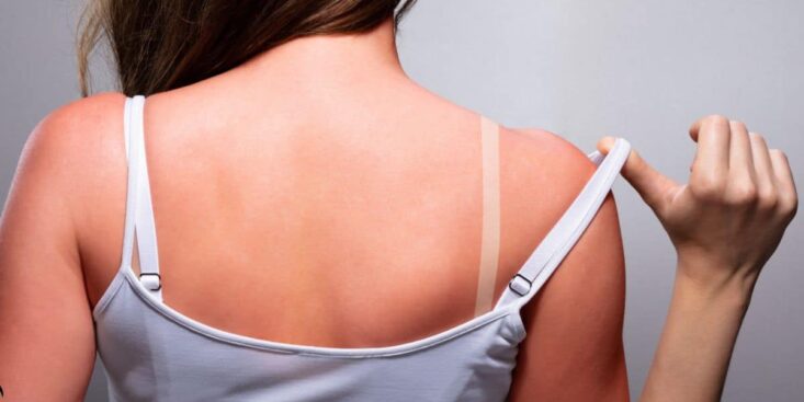 Les meilleures astuces pour ne pas peler après à un coup de soleil